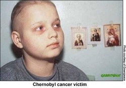 250px-Ch18chernobylcancervictim.JPG.jpeg