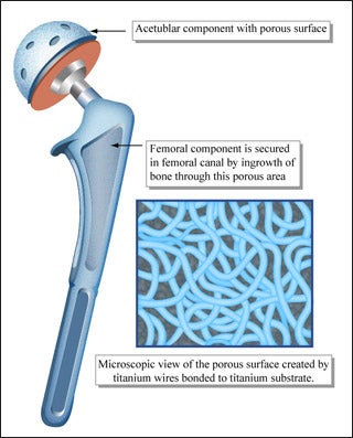 Drawing of hip implant, highlighting porous surfaces for tissue ingrowth.