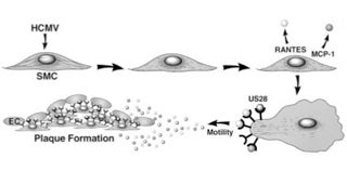 Atherosclerotic plaque formation