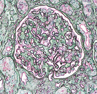 Artistic rendition of a kidney glomerulus.