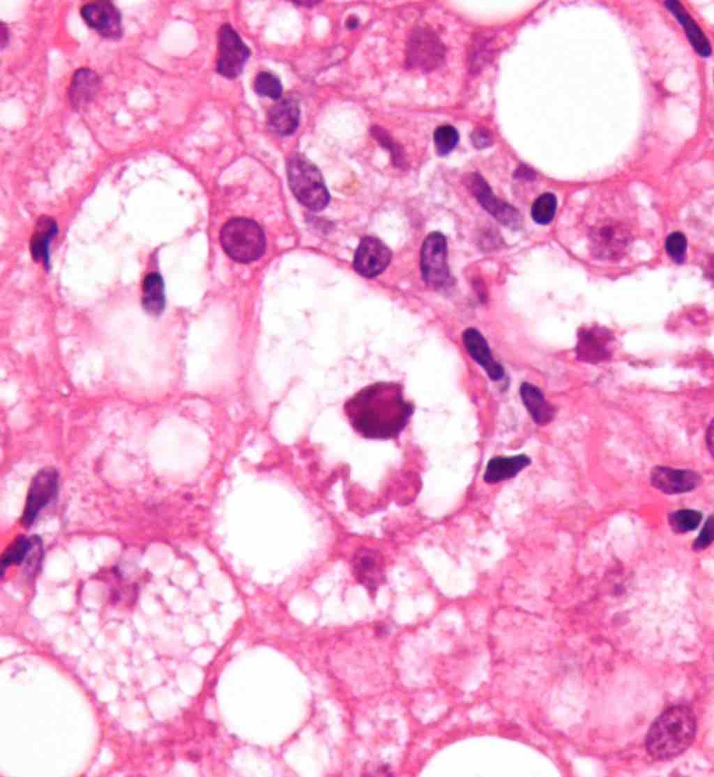 Liver tissue of an alcoholic