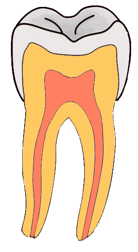 Pit and fissure caries.
