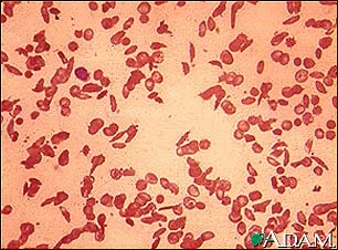 Red blood cells, sickle cells