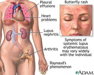 Systemic lupus erythematosus