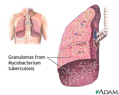 Miliary tuberculosis