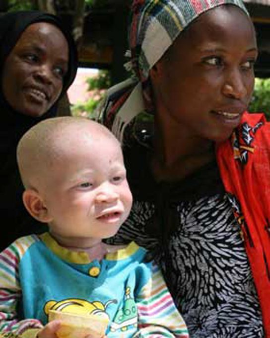 Photo shows a mother with an albino child